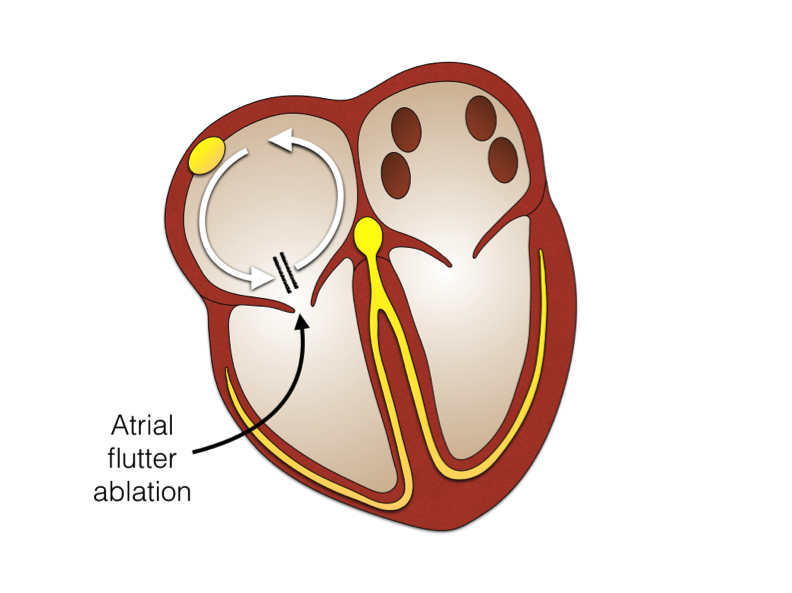 complications of atrial flutter ablation